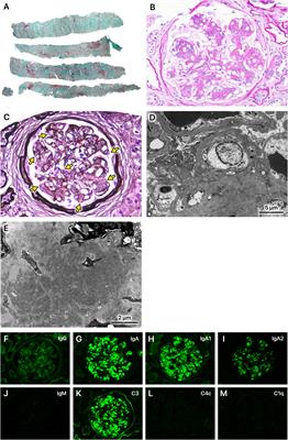 Efficacy of SGLT2 inhibitors in IgA nephropathy associated with alcoholic liver cirrhosis accompanied by nephrotic syndrome: a case report